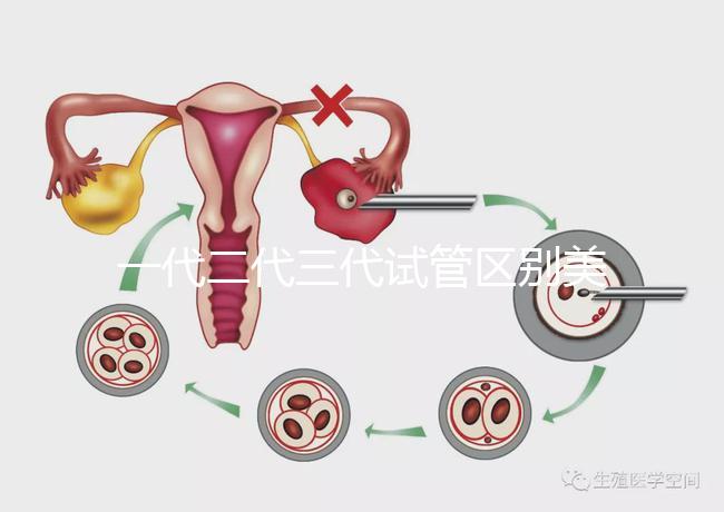一代二代三代試管區(qū)別美琳達(一代二代三代試管區(qū)別及價格)