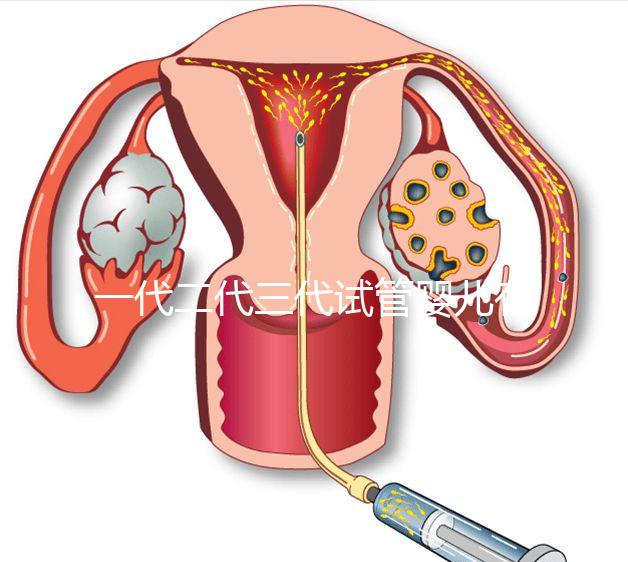 一代二代三代試管嬰兒有什么區(qū)別？
