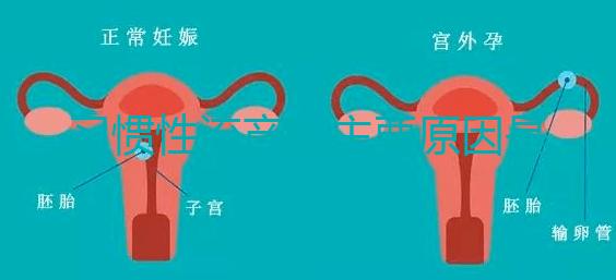 習慣性流產的主要原因是什么？