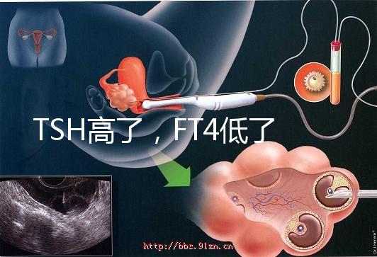 TSH高了，FT4低了，需要補碘嗎？